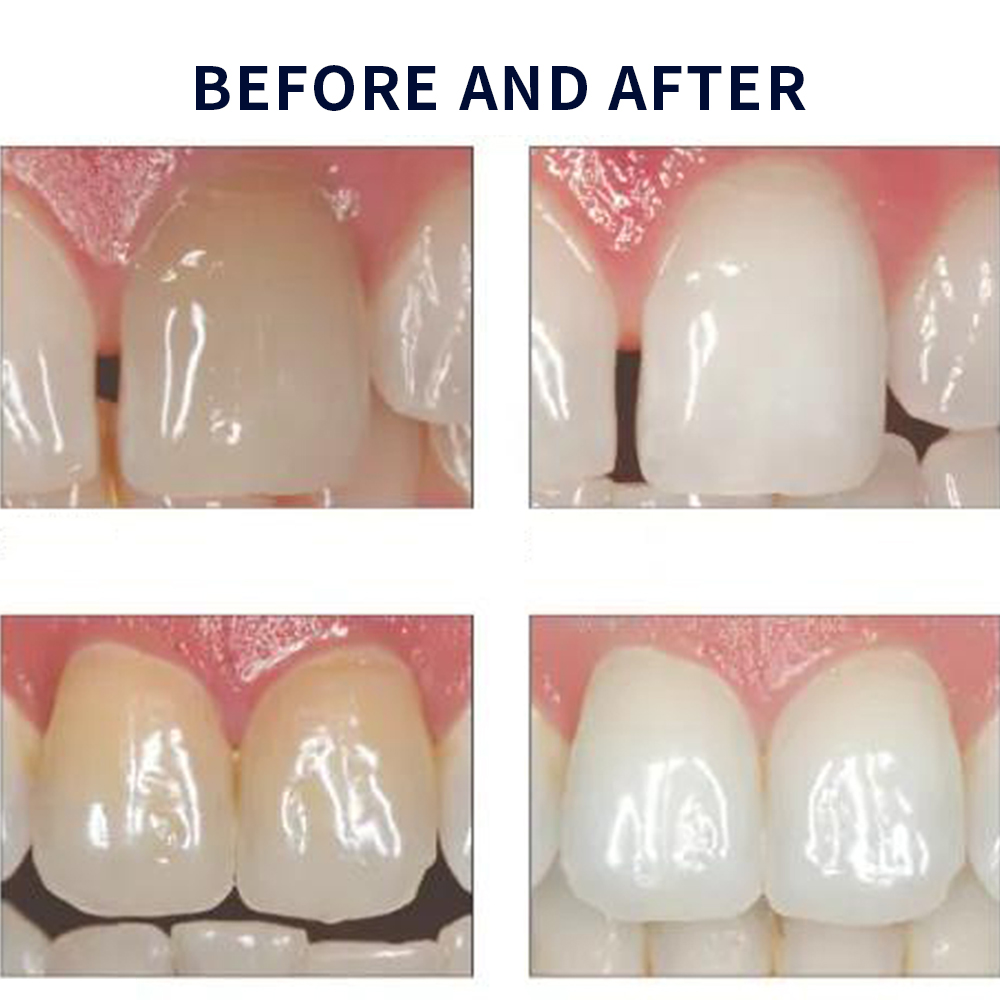 Opalescence Whitening 20% PF 2 - Teeth Whitening Led Kit recension och pris