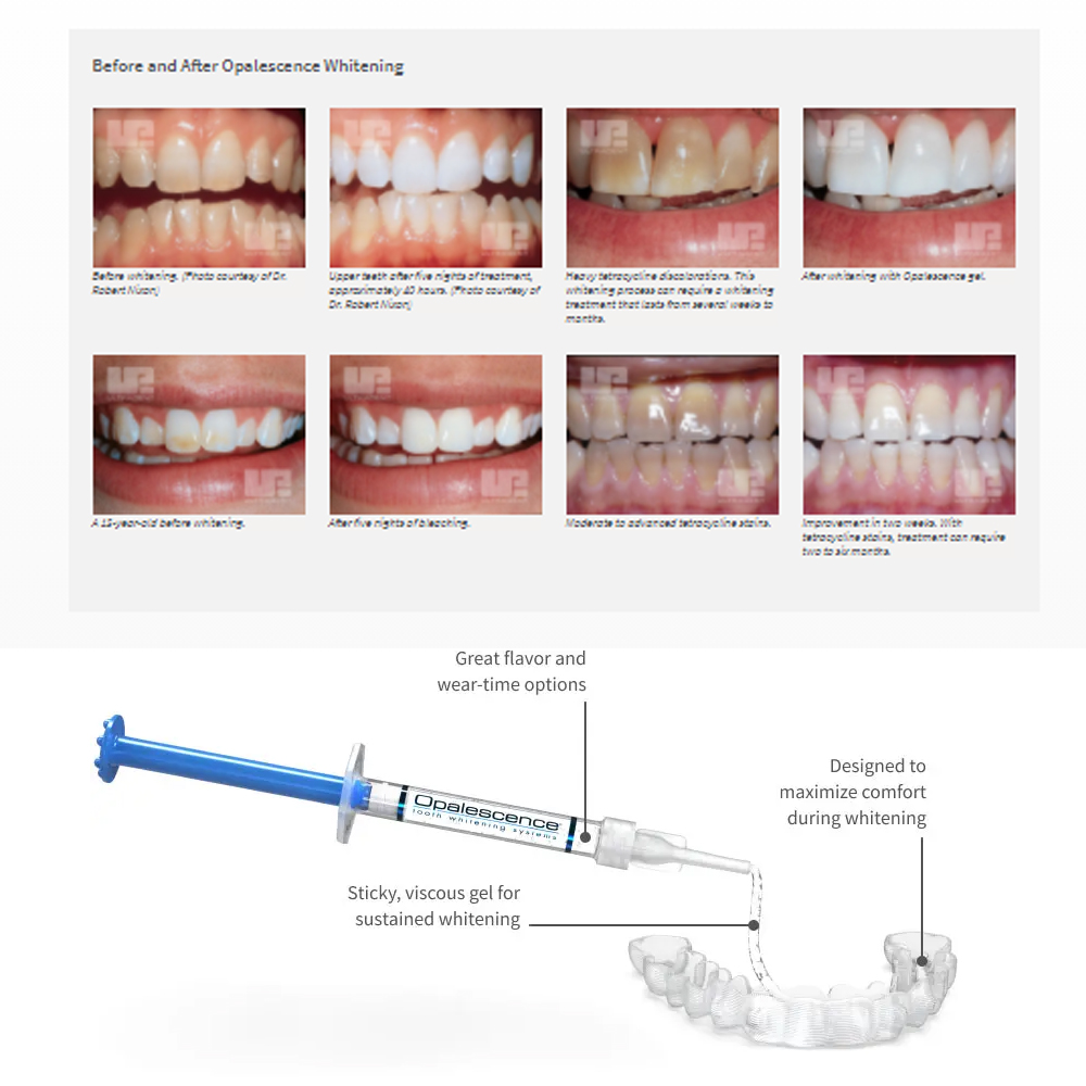 Opalescence Whitening 20% PF 2 - Teeth Whitening Led Kit recension och pris