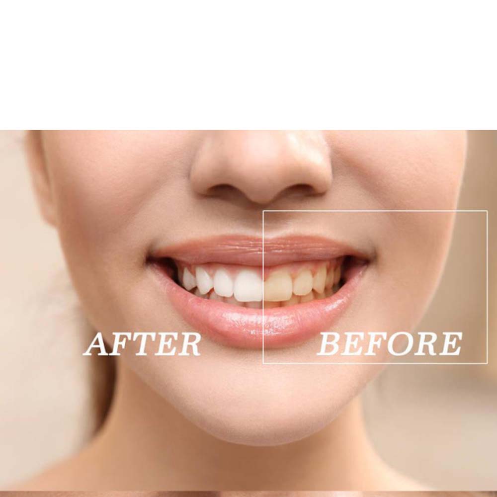 Top Quality Peroxide Teeth Whi - Teeth Whitening Led Kit recension och pris