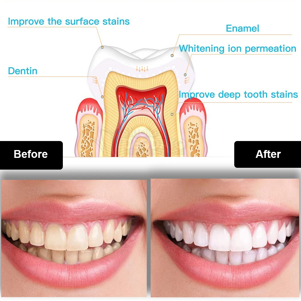 Dental Teeth Whitening Kit Min - Teeth Whitening Led Kit recension och pris